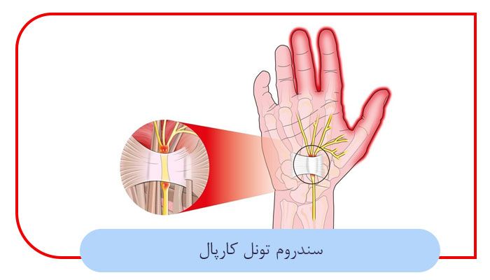 سندروم-تونل-کارپال