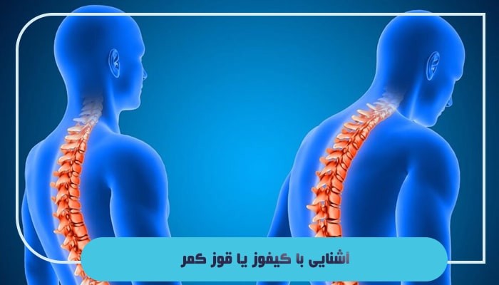 قوز کمر یا کیفوز چیست؛ آیا این بیماری 100 درصد قابل درمان است؟ 1 آشنایی با کیفوز یا قوز کمر