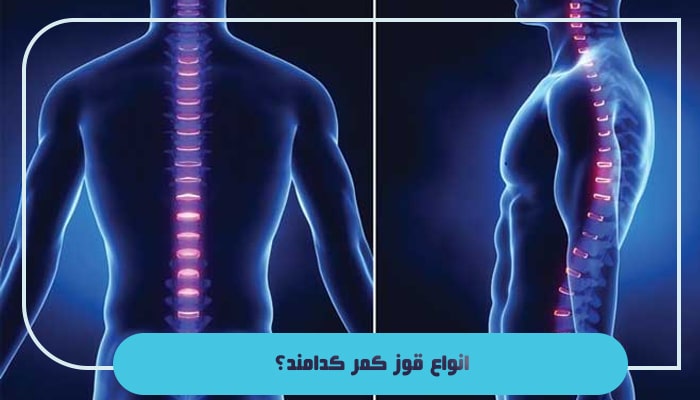 قوز کمر یا کیفوز چیست؛ آیا این بیماری 100 درصد قابل درمان است؟ 3 انواع قوز کمر کدامند؟