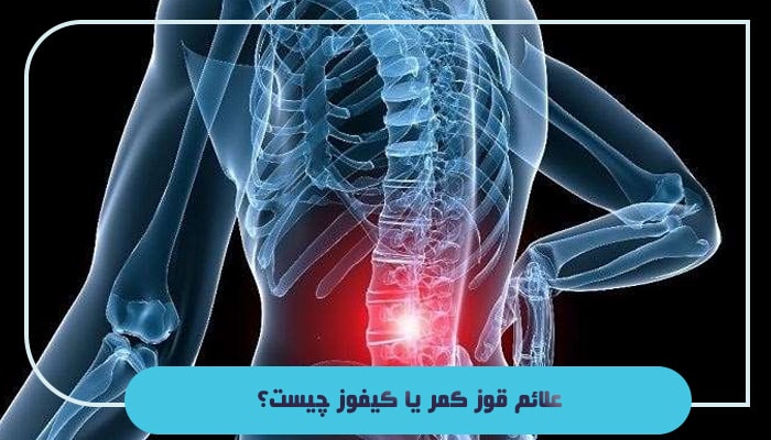 قوز کمر یا کیفوز چیست؛ آیا این بیماری 100 درصد قابل درمان است؟ 2 علائم قوز کمر یا کیفوز چیست؟
