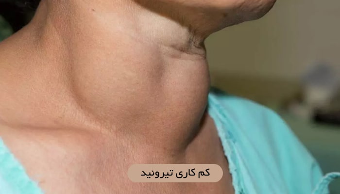 کم کاری تیروئید؛ علل، علائم و 1 درمان موثر 1 کم کاری تیروئید