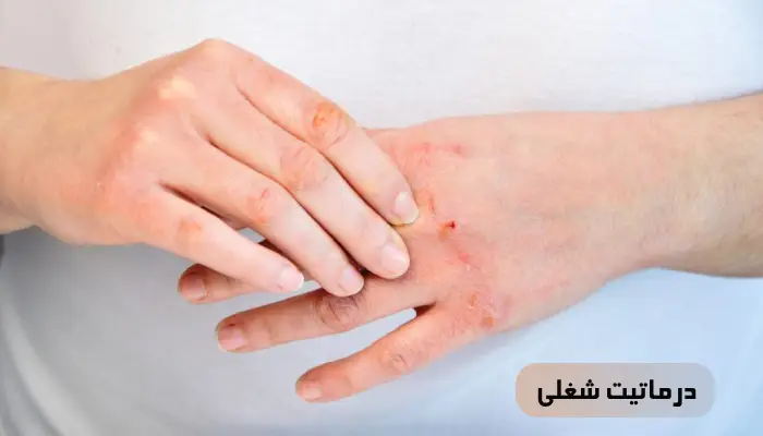 درماتیت شغلی