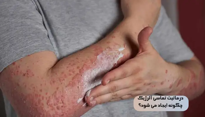درماتیت تماسی آلرژیک چگونه ایجاد می شود؟