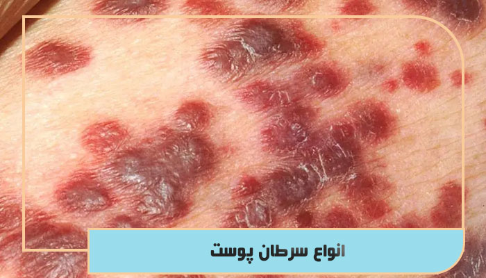 انواع سرطان پوست