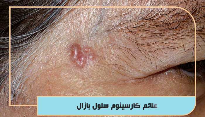 علائم کارسینوم سلول بازال